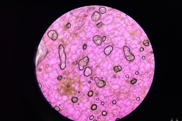 Spatial Biology: Bridging Data, Discovery, and Diagnostics