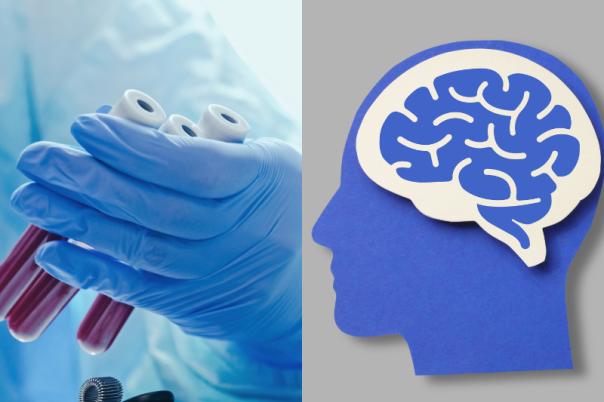 UCL Scientists Uncover New Biomarkers for Dementia with Lewy Bodies